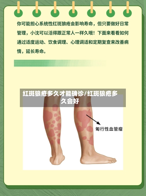 红斑狼疮多久才能确诊/红斑狼疮多久会好
