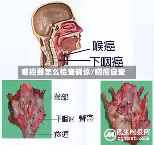 咽癌要怎么检查确诊/咽癌自查-第2张图片
