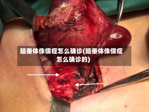 脑垂体侏儒症怎么确诊(脑垂体侏儒症怎么确诊的)