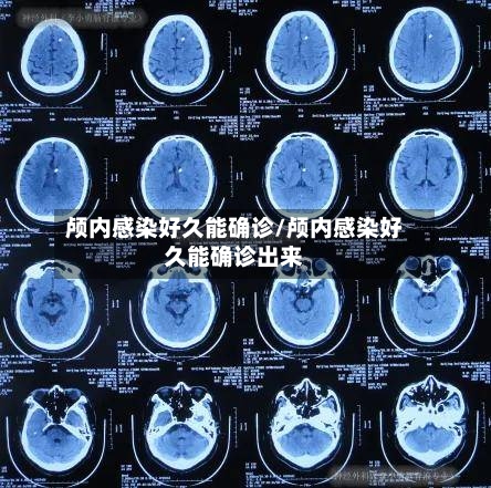 颅内感染好久能确诊/颅内感染好久能确诊出来-第2张图片