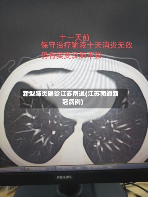新型肺炎确诊江苏南通(江苏南通新冠病例)-第2张图片