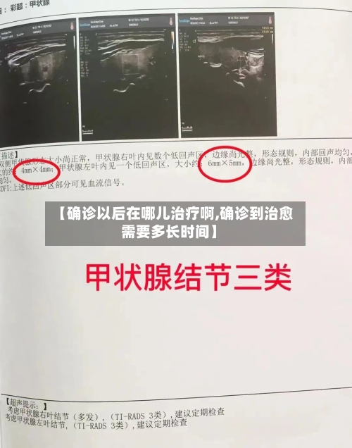 【确诊以后在哪儿治疗啊,确诊到治愈需要多长时间】