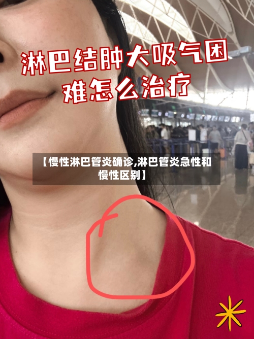 【慢性淋巴管炎确诊,淋巴管炎急性和慢性区别】