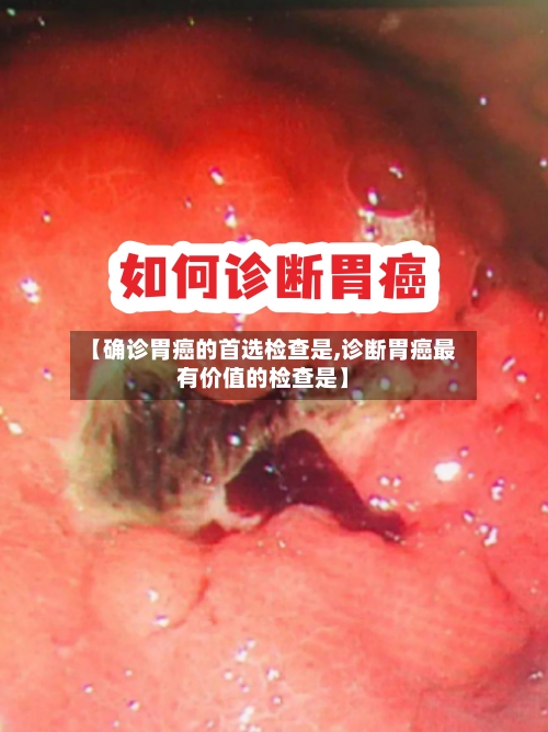 【确诊胃癌的首选检查是,诊断胃癌最有价值的检查是】-第2张图片