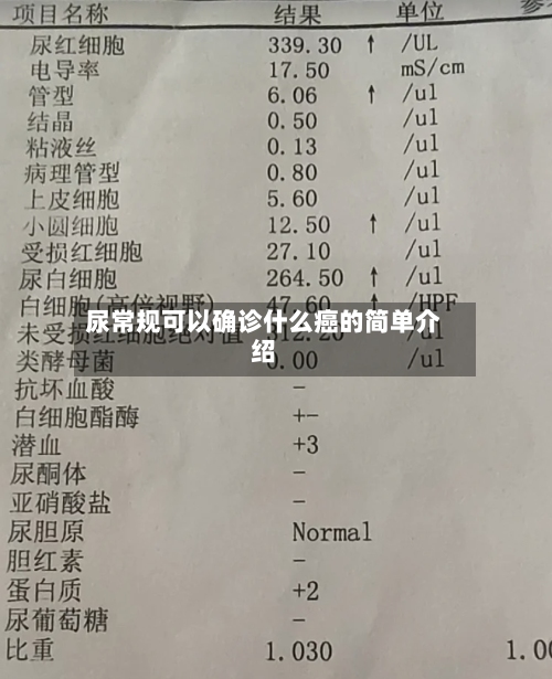 尿常规可以确诊什么癌的简单介绍-第3张图片