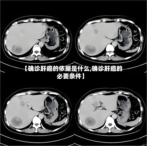 【确诊肝癌的依据是什么,确诊肝癌的必要条件】