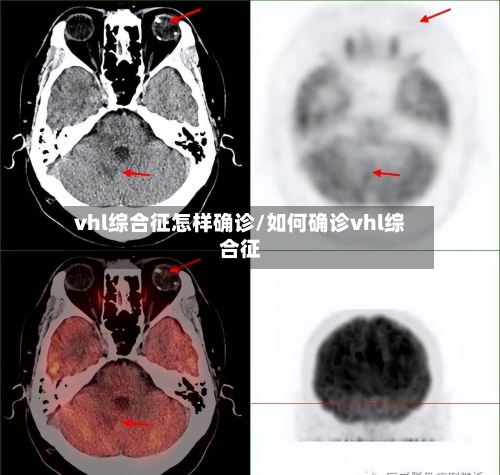 vhl综合征怎样确诊/如何确诊vhl综合征-第2张图片